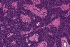 Luminal cell rich pleomorphic adenoma of the hard palate