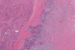 Pleomorphic adenoma
