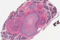 Pleomorphic adenoma of the parotid gland