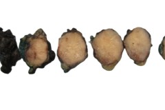 Pleomorphic adenoma of the parotid gland