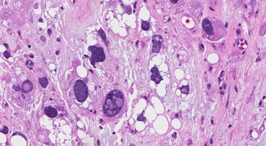 Pleomorphic liposarcoma