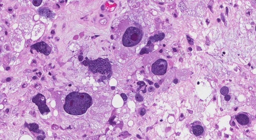 Pleomorphic liposarcoma