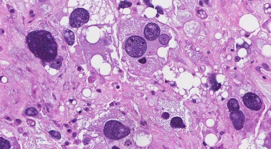 Pleomorphic liposarcoma
