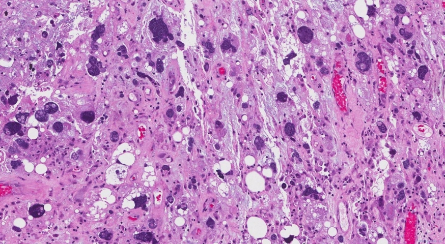 Pleomorphic liposarcoma