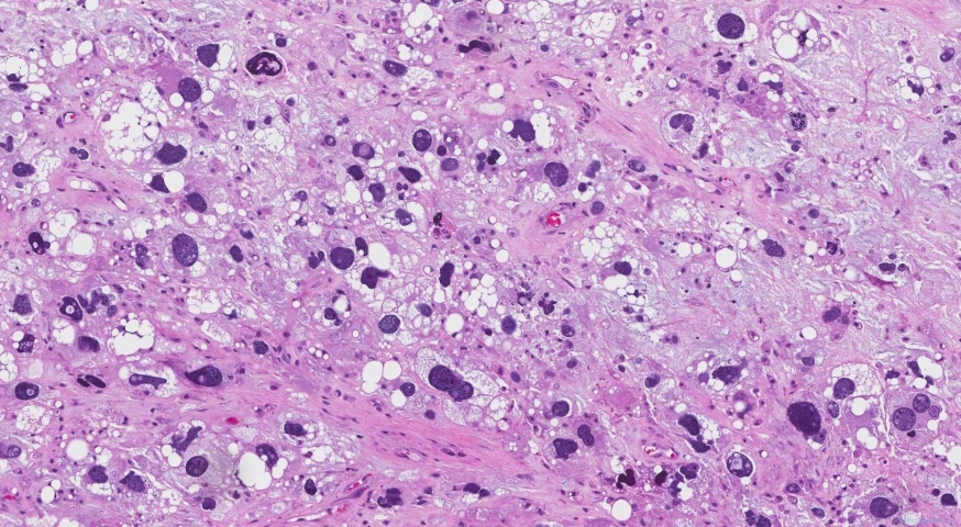 Pleomorphic liposarcoma