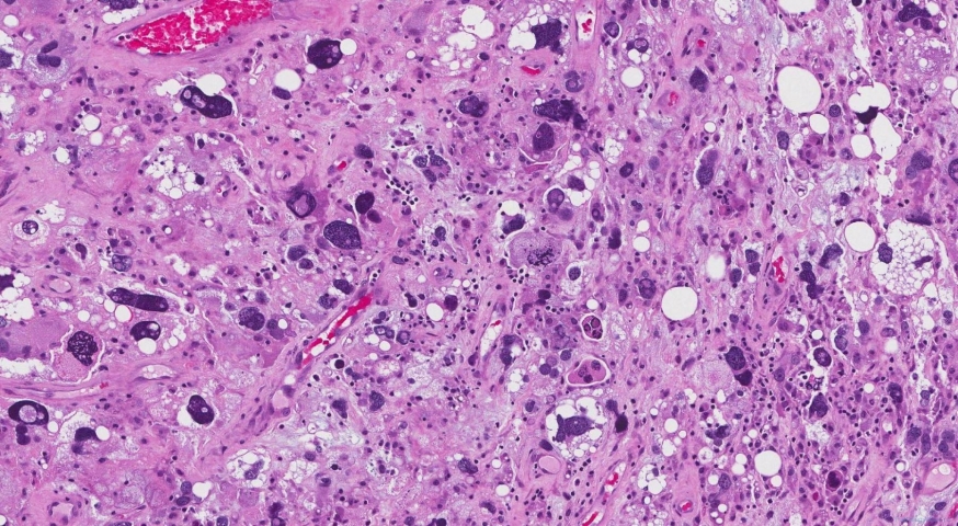 Pleomorphic liposarcoma