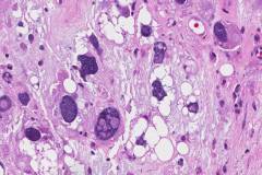 Pleomorphic liposarcoma