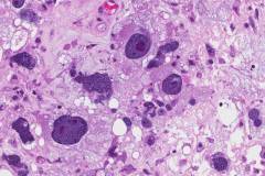 Pleomorphic liposarcoma