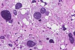 Pleomorphic liposarcoma