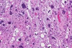 Pleomorphic liposarcoma