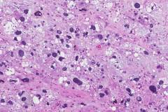 Pleomorphic liposarcoma