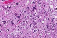 Pleomorphic liposarcoma