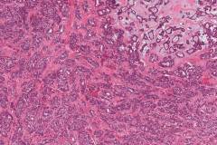 Metastatic polymorphous adenocarcinoma, cribriform subtype