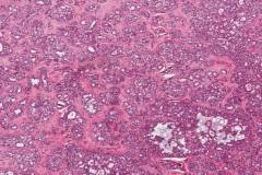 Metastatic polymorphous adenocarcinoma, cribriform subtype