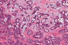 Metastatic polymorphous adenocarcinoma, cribriform subtype