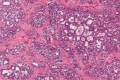 Metastatic polymorphous adenocarcinoma, cribriform subtype