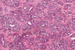 Metastatic polymorphous adenocarcinoma, cribriform subtype