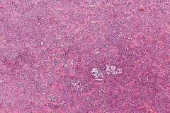 Metastatic polymorphous adenocarcinoma, cribriform subtype