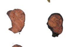 Poorly differentiated thyroid carcinoma arising from a background of widely invasive oncocytic carcinoma