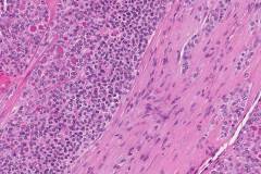 Poorly differentiated thyroid carcinoma