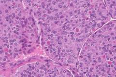 Poorly differentiated thyroid carcinoma