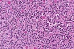 Poorly differentiated thyroid carcinoma