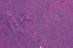 Poorly differentiated thyroid carcinoma