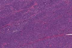 Poorly differentiated thyroid carcinoma