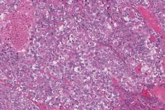 Poorly differentiated thyroid carcinoma