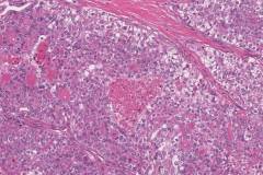 Poorly differentiated thyroid carcinoma