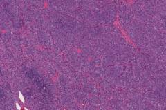 Poorly differentiated thyroid carcinoma