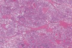 Poorly differentiated thyroid carcinoma