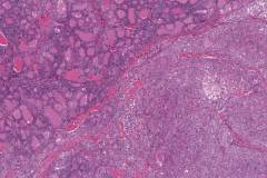 Poorly differentiated thyroid carcinoma arising from a better differentiated tumour