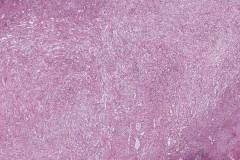 Post operative spindle cell nodule in the bladder
