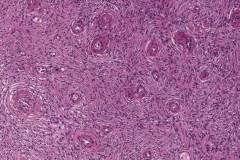 Post operative spindle cell nodule in the bladder