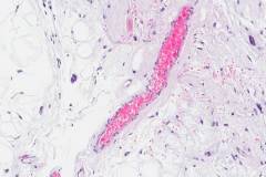 Prolapsed orbital fat