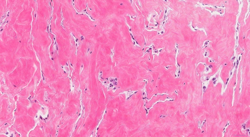 Pseudoangiomatous hyperplasia (PASH) of the breast