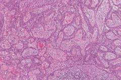 Radicular cyst