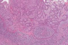 Radicular cyst