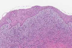 Radicular cyst