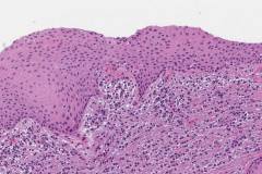 Radicular cyst