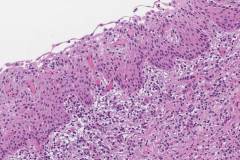 Radicular cyst