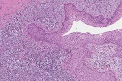 Radicular cyst
