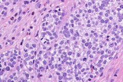 Round cell sarcoma with EWSR1-NFATC2 fusion