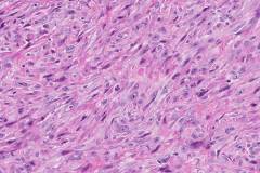 Sarcomatoid mesothelioma