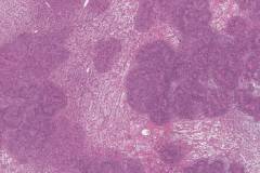 Schwannoma of the parotid gland