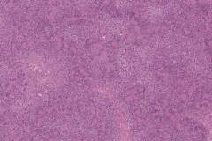 Schwannoma of the parotid gland