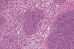 Schwannoma of the parotid gland