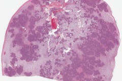 Schwannoma of the parotid gland