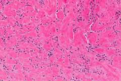 Sclerosing epithelioid fibrosarcoma